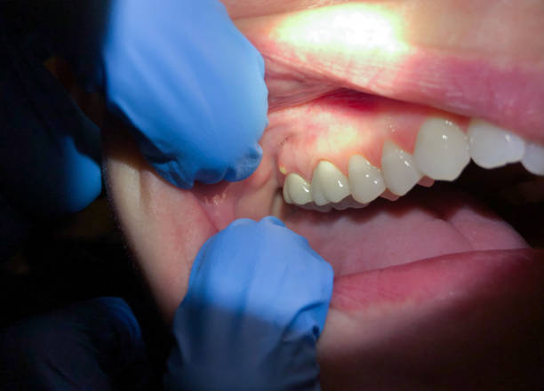 Best Emergency Dental Care for Broken or Chipped Teeth in French Valley, CA