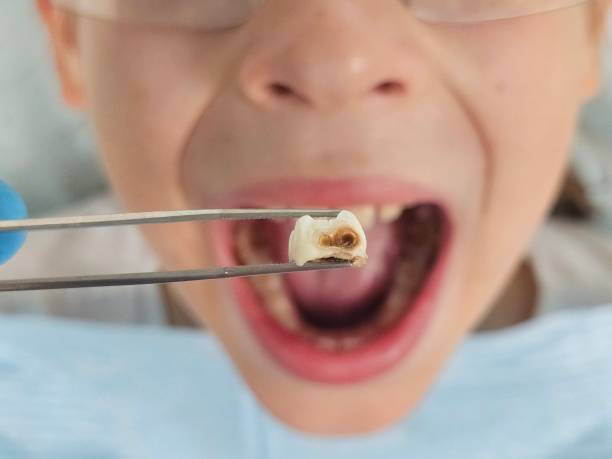 Best Emergency Treatment for Dental Infections or Abscesses in French Valley, CA
